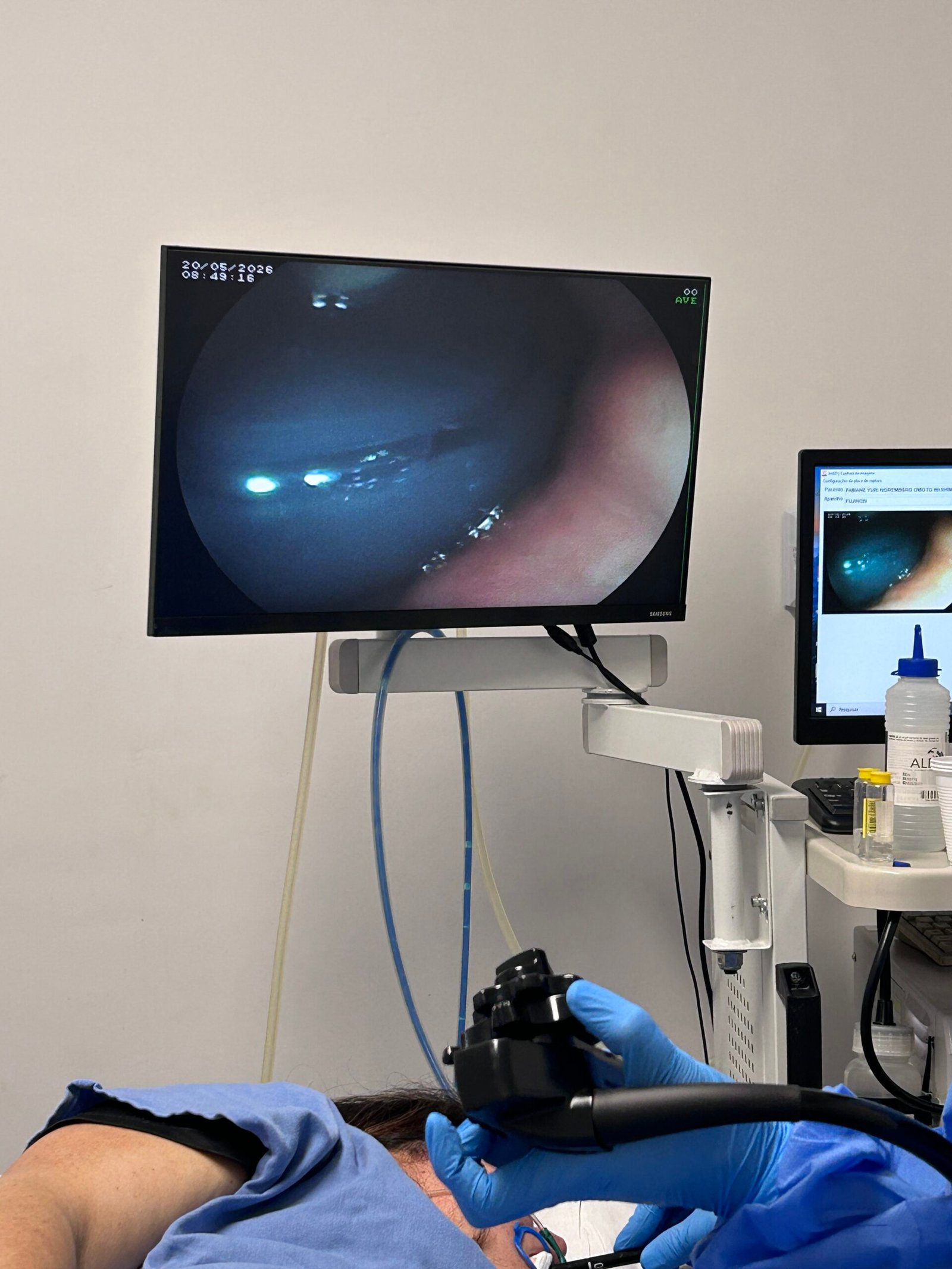 Procedimento endoscópico de balão intragástrico realizado pelo Dr. Leonardo Sato